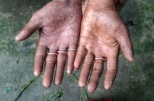Как живет семья из Бангладеша, у которой отсутствуют отпечатки пальцев на руках